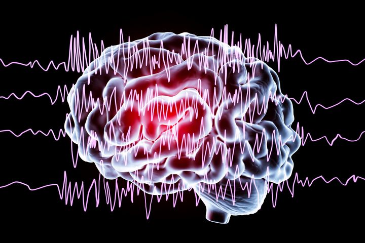 Was Sollte Man Bei Epilepsie Vermeiden