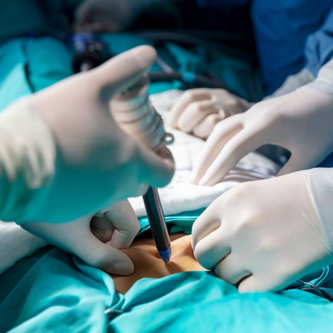 Bauchspiegelung bei Endometriose Was erwartet Sie? Medisiegel.de